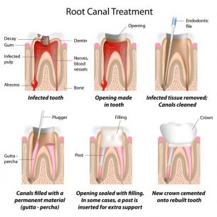 root canal diagram Dental Care Center
