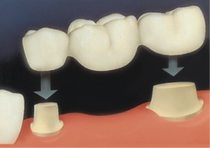 Bridge lost teeth Dental Care Center