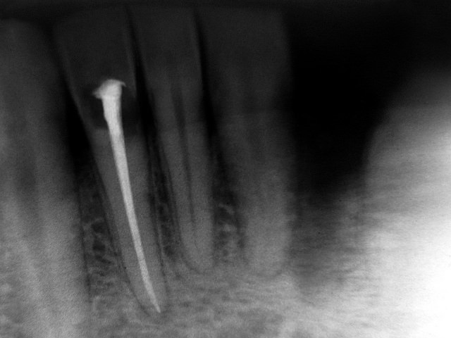 root canal x-ray Dental Care Center