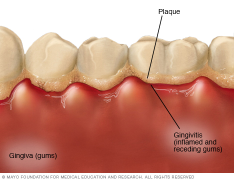 gingivitis, gums Dental Care Center